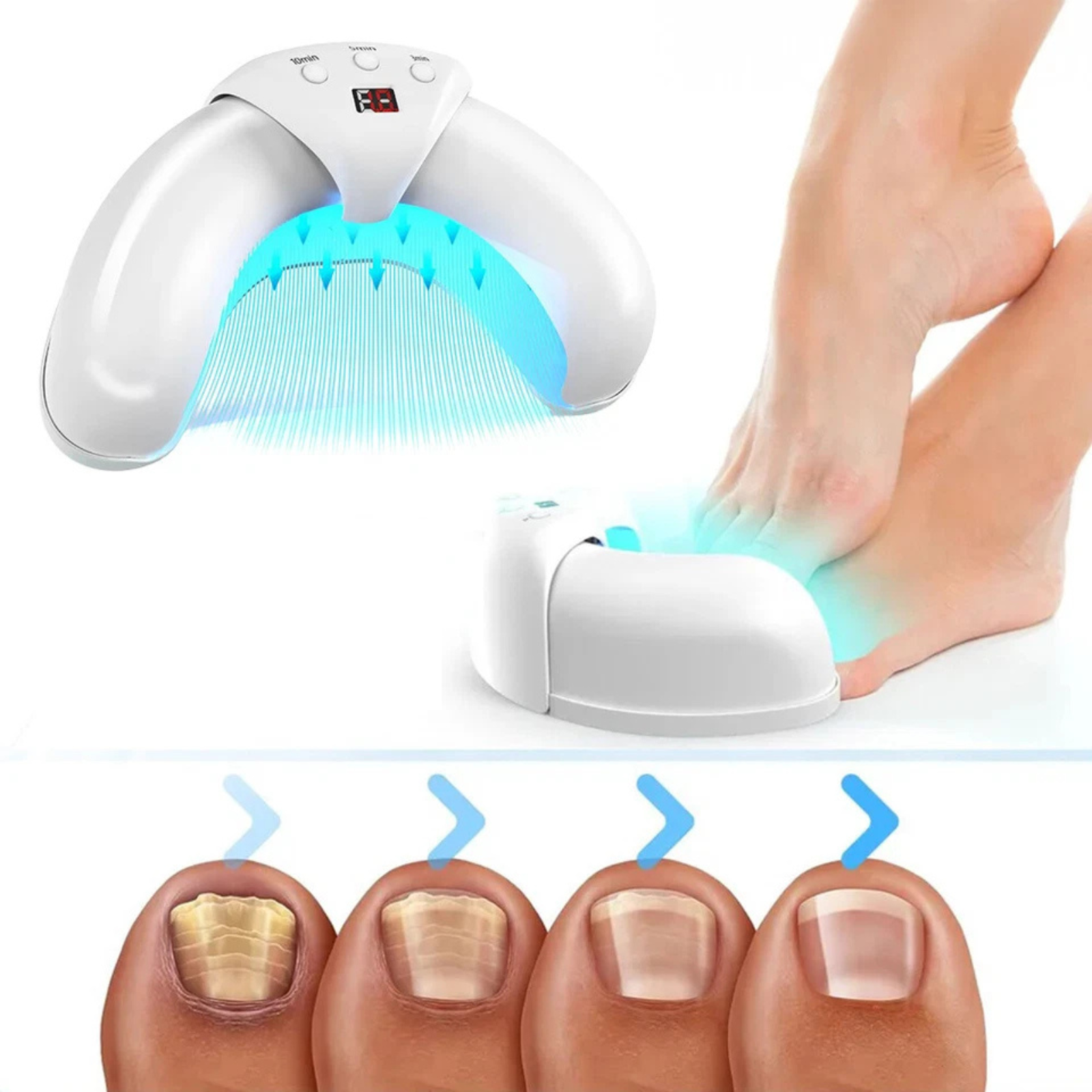 Blue Light Laser Device Nail Fungus Cleaning Treatment Tool for Toenails