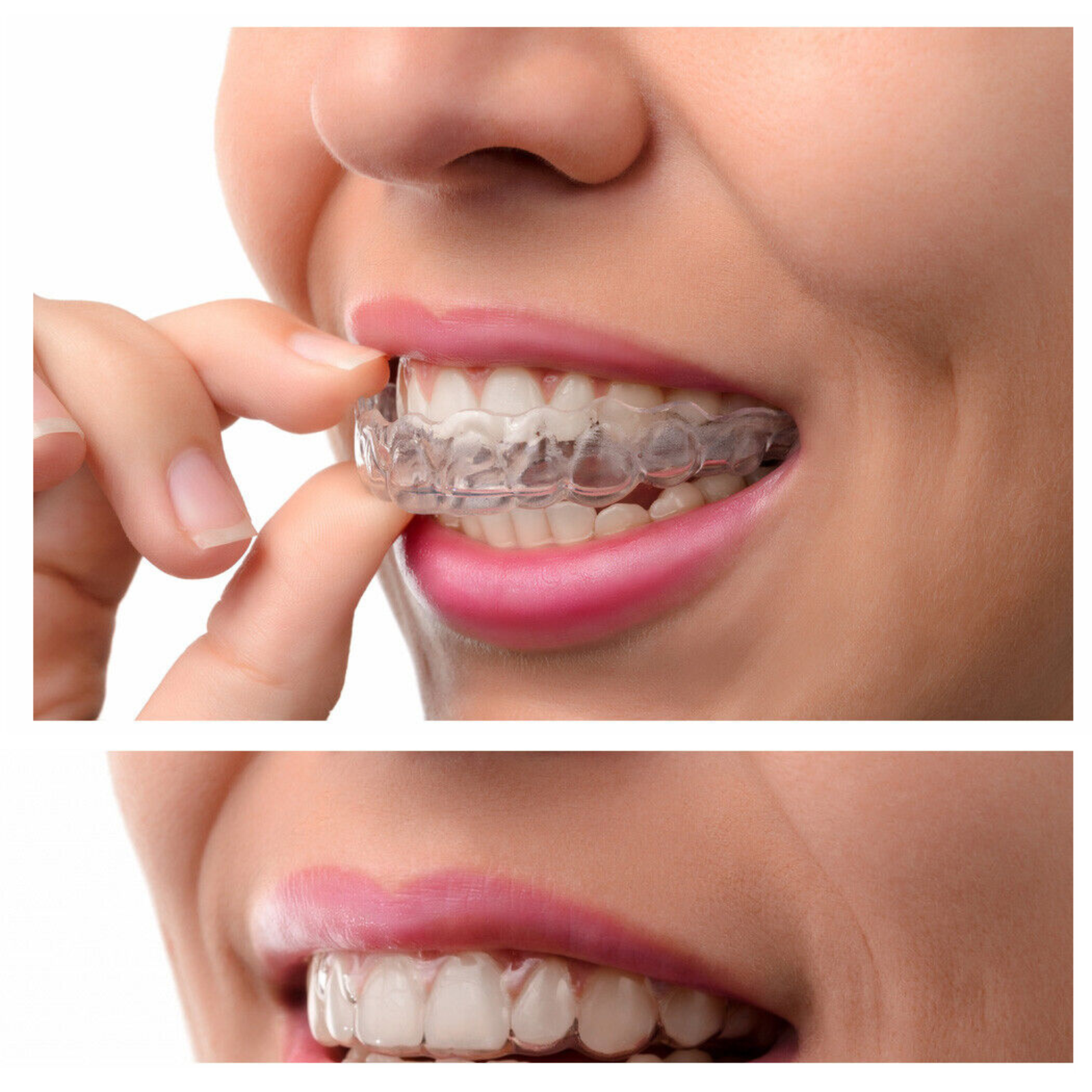 Mouth Guard Sleeping Dental  Night Bruxism Clenching Teeth Grinding