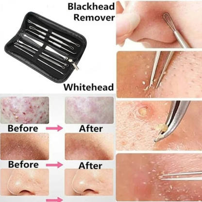 Extractor Remover 8pcs Pimple Popper Blackhead Acne Clip Needle Tweezer